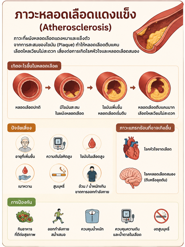 ภาวะหลอดเลือดแดงแข็ง (Atherosclerosis) - เส้นเลือดในสมองตีบ 6 สัญญาณอันตรายอาการเส้นเลือดในสมองตีบ