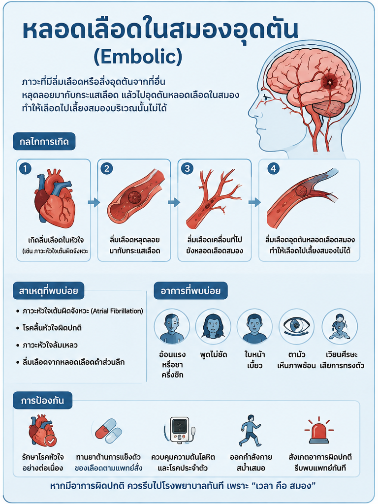 หลอดเลือดในสมองอุดตัน (Embolic) - เส้นเลือดในสมองตีบ 6 สัญญาณอันตรายอาการเส้นเลือดในสมองตีบ