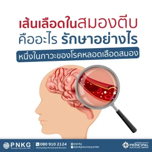 เส้นเลือดในสมองตีบ คืออะไร รักษาอย่างไร หนึ่งในภาวะของโรคหลอดเลือดสมอง