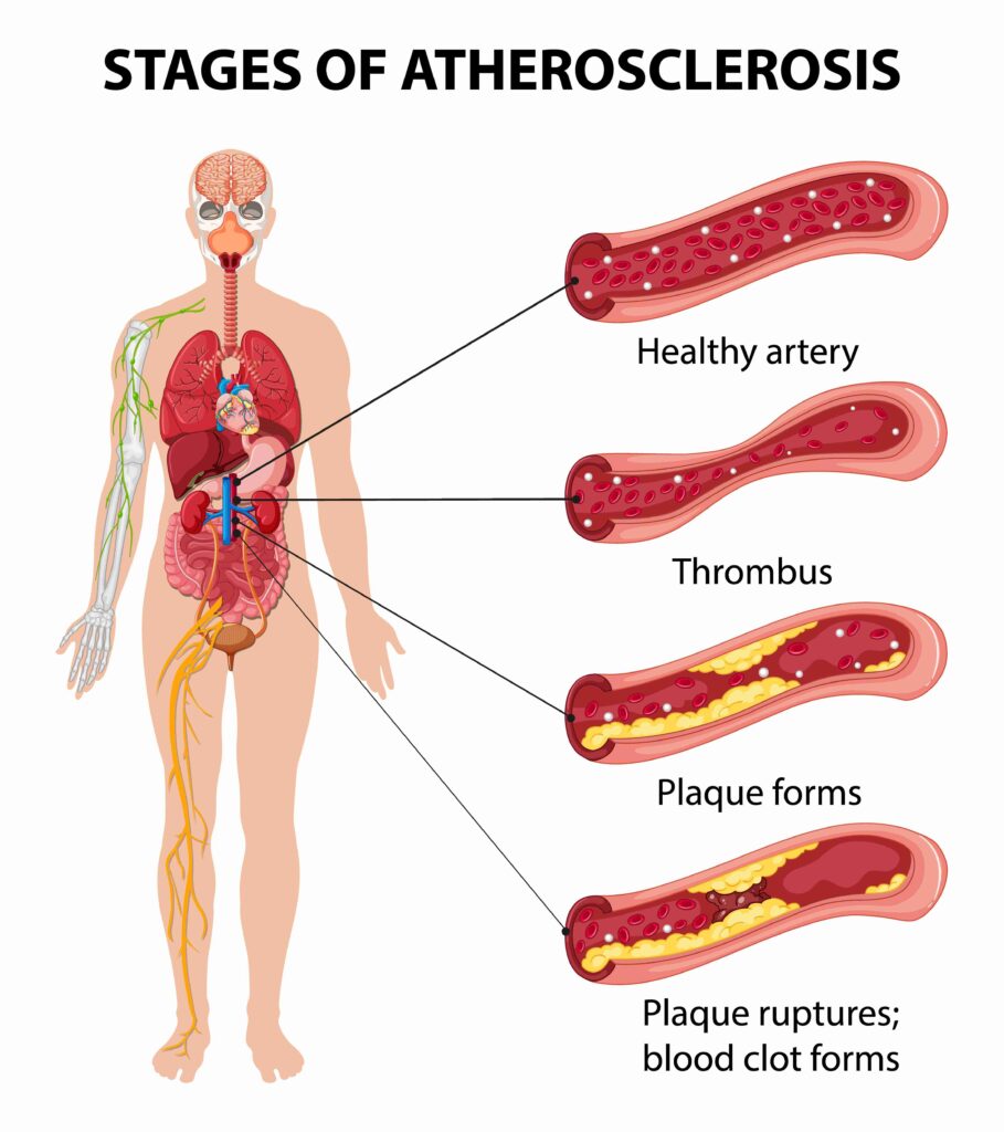 Atherosclerosis คือ ภาวะที่หลอดเลือดแดงหนาตัวและแข็งตัวผิดปกติจากการสะสมของไขมัน คอเลสเตอรอล เกล็ดเลือด แคลเซียม และเม็ดเลือดขาว (WBC) บริเวณผนังหลอดเลือด เมื่อสะสมเรื่อย ๆ สารเหล่านี้จะรวมกันกลายเป็นแผ่นแข็งหรือคราบพลัค (Plaque) ส่งผลให้หลอดเลือดเสียความยืดหยุ่นและอักเสบ จนหลอดเลือดแข็งหรือตีบตัน ทำให้การไหลเวียนเลือดไม่สะดวก
